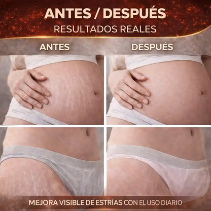 Tree Doctor ¡Crema Anti-Estrías y elasticidad!
