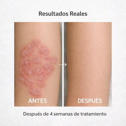 Psoriasis Solución Natural Para Calmar y Aliviar Tu Piel