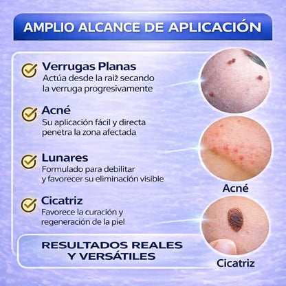 Wart Remover Elimina Tus Verrugas YA