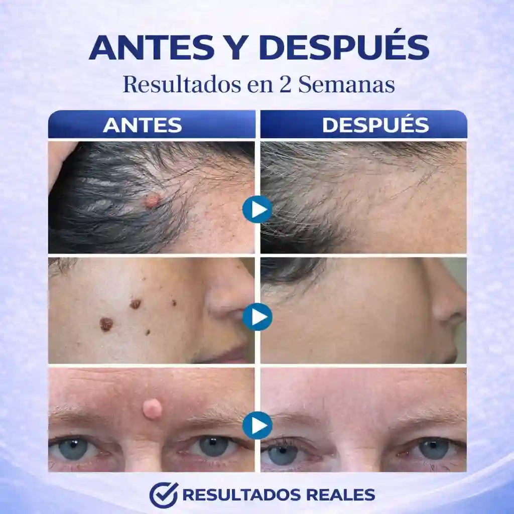 Wart Remover Elimina Tus Verrugas YA