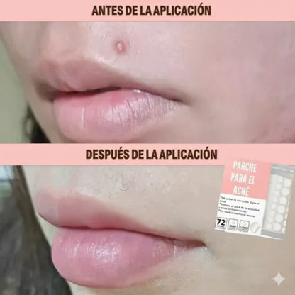 Parches invisibles Anti-Acné